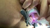 หนังโป๊ Numbing cervix with local anesthetic Mp4